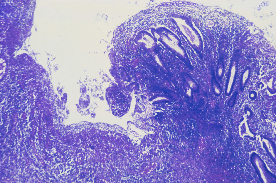 BWGE 2019 : quoi de neuf sur la colite microscopique ?